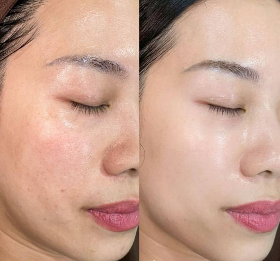 RedTouch 675 nm – Kosmetikstudio München Haidhausen – Behandlungsergebnis 1