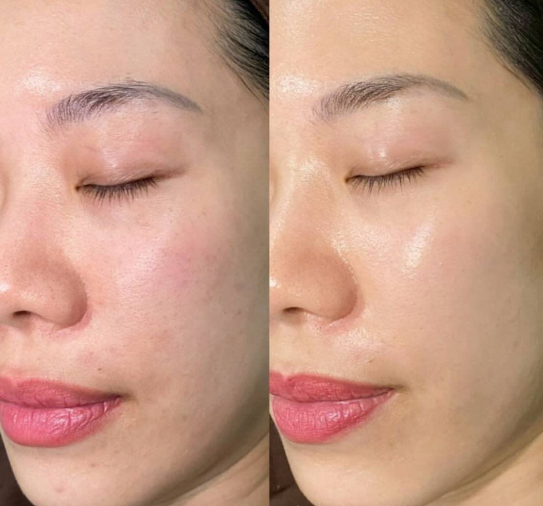 RedTouch 675 nm – Kosmetikstudio München Haidhausen – Pigmentkorrektur