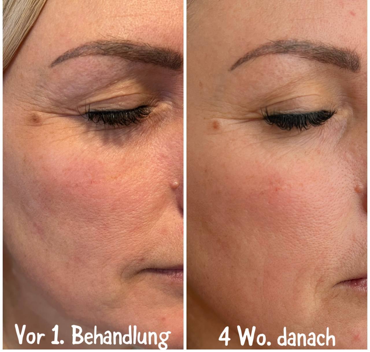 RedTouch 675 nm – Kosmetikstudio München Haidhausen – Hautverjüngung