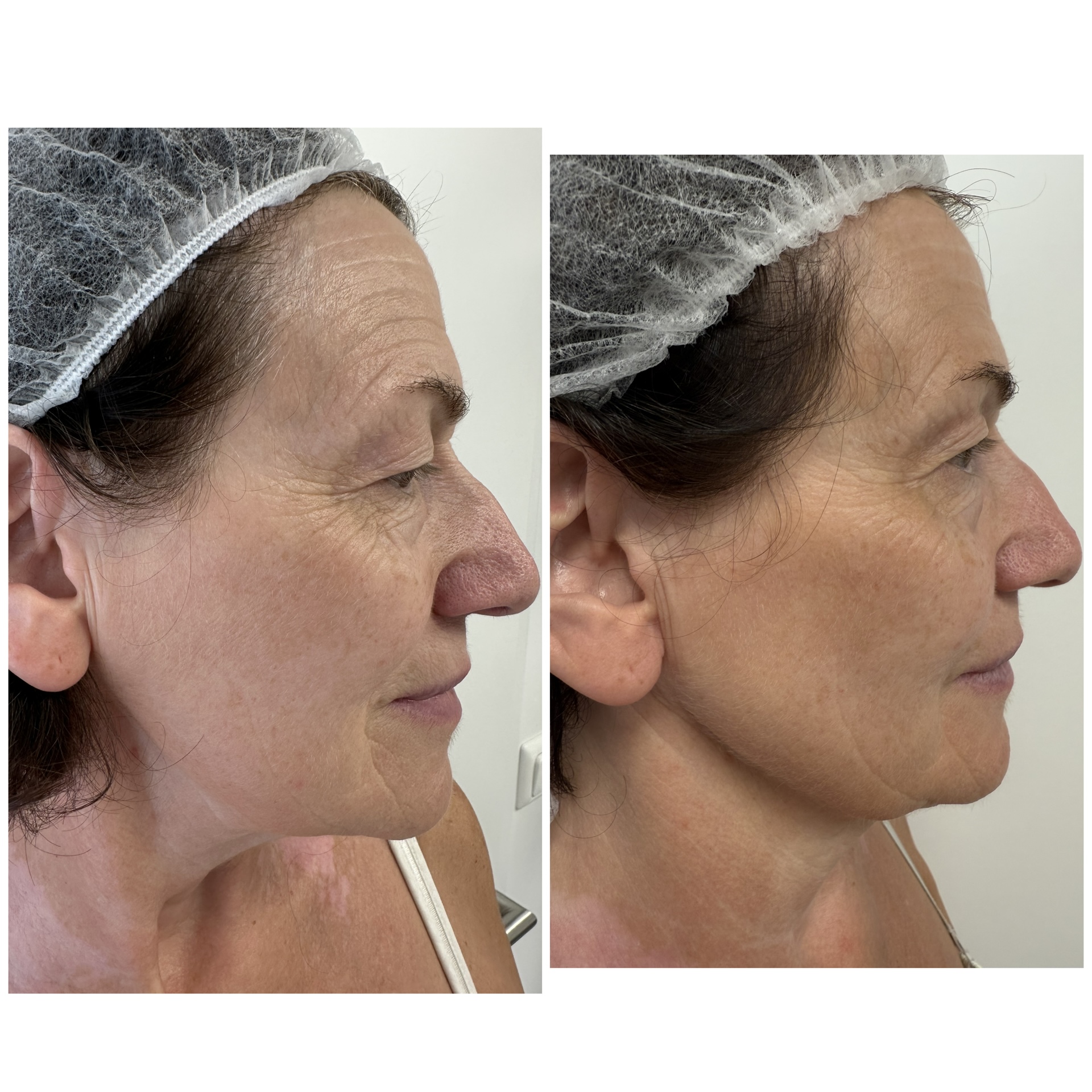 RedTouch 675 nm – Kosmetikstudio München Haidhausen – Kollagen-Stimulation