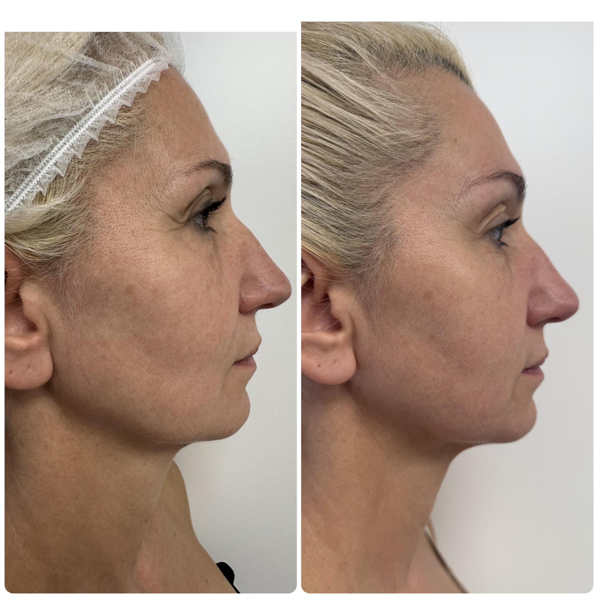 RedTouch 675 nm – Kosmetikstudio München Haidhausen – Behandlungsdetail